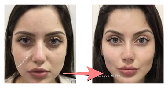 Merak Edenler Buraya: Devlet Hastanesinde Geçirdiğim Burun Estetiğini Tüm Detaylarıyla Anlatıyorum!