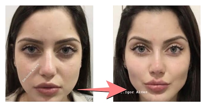 Merak Edenler Buraya: Devlet Hastanesinde Geçirdiğim Burun Estetiğini Tüm Detaylarıyla Anlatıyorum!