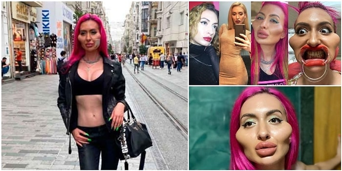 Dünyanın En Büyük Yanaklarına Sahip Olmak İçin Sürekli Dolgu Yaptıran ve Görüntüsünden Oldukça Memnun Olduğunu Söyleyen Kadın