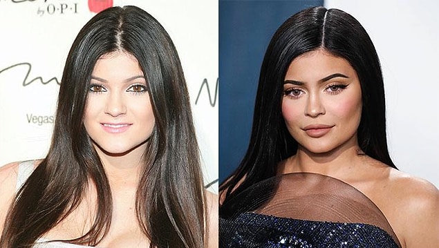 Kylie Jenner burun estetiği yaptırmış!