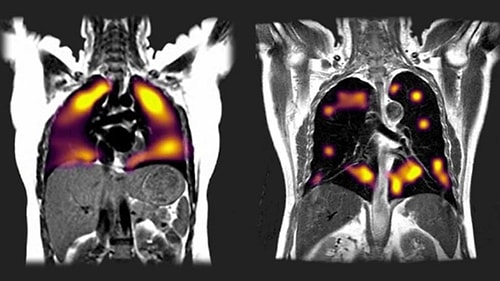 Yeni Tarama Tekniği, Koronavirüsün Akciğerlerde Neden olduğu Hasarı 'Gösterdi'