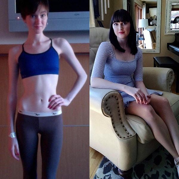 12. "8 yıldır süren Anoreksiya hastalığımdan kurtuldum ve daha önce hiç bu kadar sağlıklı ve mutlu olmamıştım."