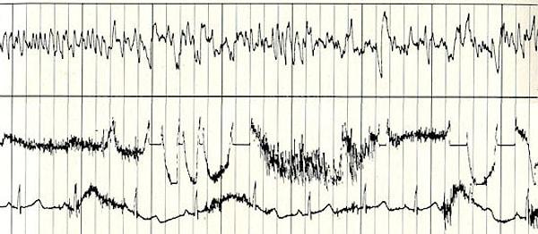 Druyan düşüncelere dalmışken EEG kayıtları alınmıştı ve tam olarak şöyleydi. 👇