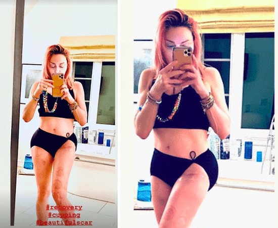 Мадонна поделилась в Instagram кадрами, демонстрирующими не только ее впечатляющий пресс, но и шрам после операции на бедре