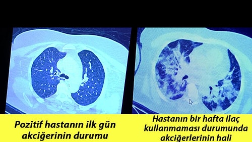 İnanılmaz Fark! Koronavirüse Yakalanıp İlaç Kullanan Ve Kullanmayan Bir Hastanın Akciğerleri