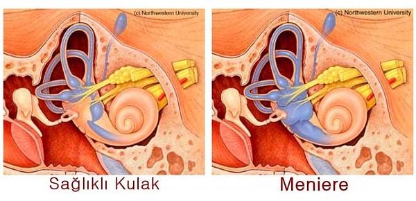 Meniere hastalığı, iç kulaktaki salyangoz şeklindeki denge bölümünün aşırı basınç altında kalması ile oluşan bir rahatsızlık.