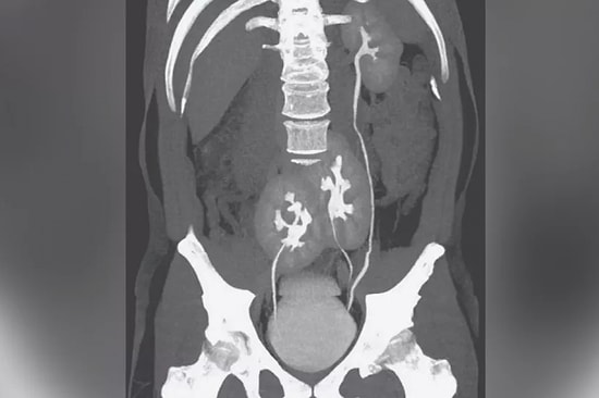Gezen Dalak, Alkol Üreten Mesane: 2020'nin En İlginç 5 Tıbbi Vakası