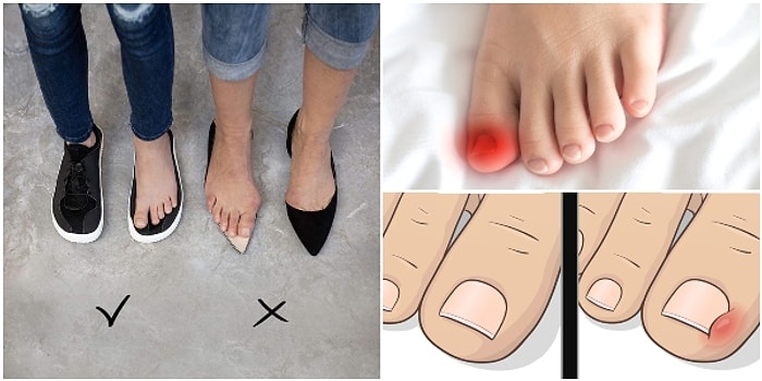 Düşman Başına Bir İllet Olan Batık Tırnak Nedir ve Nasıl Tedavi Edilir?