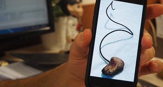 Ameliyatta Unutulan 28 Cm'lik Katater Operasyonla Çıkarıldı