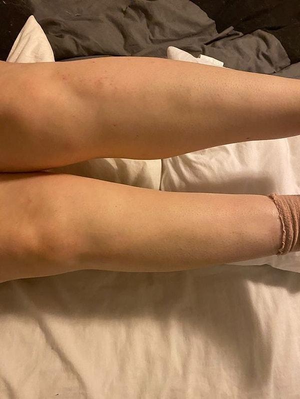 8. "Bacak kaslarımdaki farklılık, bilek ameliyatından 3 hafta sonra."