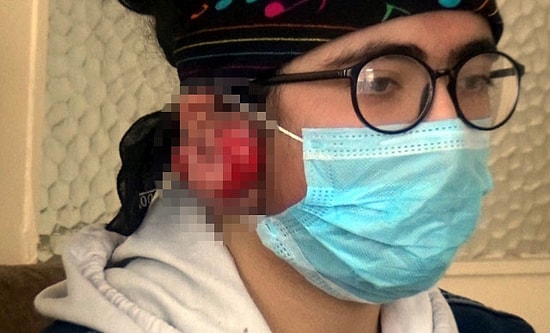7 Yaşında Taktığı Küpeler Kabusu Oldu! Kulaklarında Keloid Oluşan Yağmur, Tedavi Olamazsa Duyamayacak