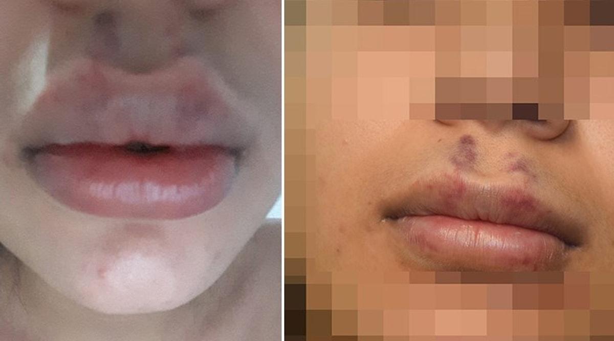 30 kisinin bulundugu evde tanimadigi kisiye botoks yaptirdi dudaklarini kaybetme tehlikesiyle karsi karsiya