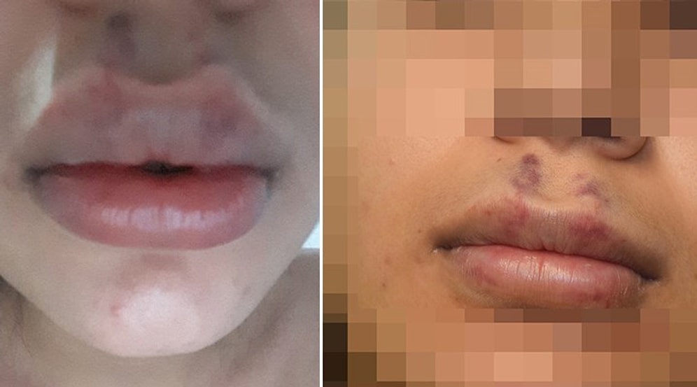 30 Kişinin Bulunduğu Evde Tanımadığı Kişiye Botoks Yaptırdı, Dudaklarını Kaybetme Tehlikesiyle Karşı Karşıya