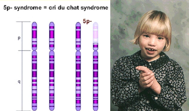Cri du chat sendromunun belirtileri nelerdir?