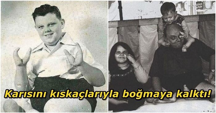 El Yerine Kıskaçlara Sahip Olan "Istakoz Çocuk" Grady Stiles ve Trajik Hayat Hikayesi