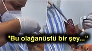Daha Neler! Ağzıyla Balık Tutmaya Çalışan Talihsiz Adamın Yemek Borusundan 18 Cm Boyunda Balık Çıkarıldı