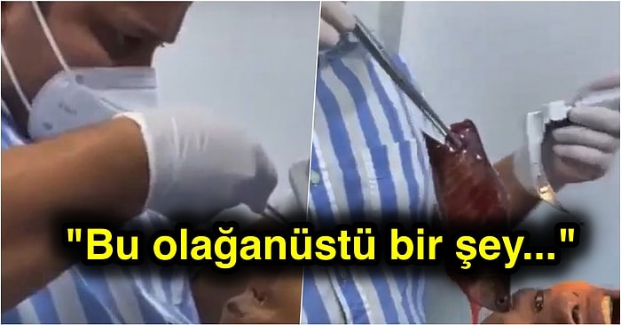 Daha Neler! Ağzıyla Balık Tutmaya Çalışan Talihsiz Adamın Yemek Borusundan 18 Cm Boyunda Balık Çıkarıldı