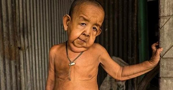 Progeria sendromu telomer zincirin kısalığından kaynaklanıyor. Yani en basit tabiriyle aslında DNA’sı kısalıyor.