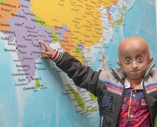 Progeria düşünülenin aksine kalıtsal bir hastalık değil yani aslında aileden çocuğa aktarılmıyor.