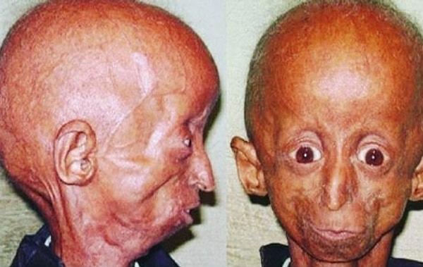 Hastalığımızın adı Progeria sendromu. Halk arasında 'Benjamin Button sendromu' olarak da biliyor. Yani daha da Türkçesi erken yaşlanma hastalığı.