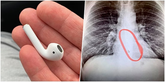 Boğaz Kuruluğu Şikayetiyle Doktora Gitti, Kulaklığını Yuttuğu Ortaya Çıktı