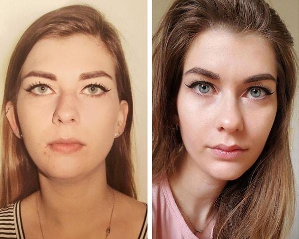 12. "İki çene ameliyatından önce ve sonra."