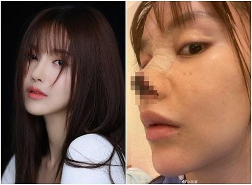 Estetik Sevdası Çinli Aktristin Hayatını Kararttı: Burun Dokusu Çürüdü!