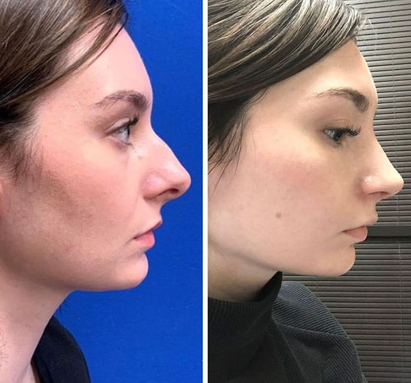 1. «Через две недели после операции на носу».