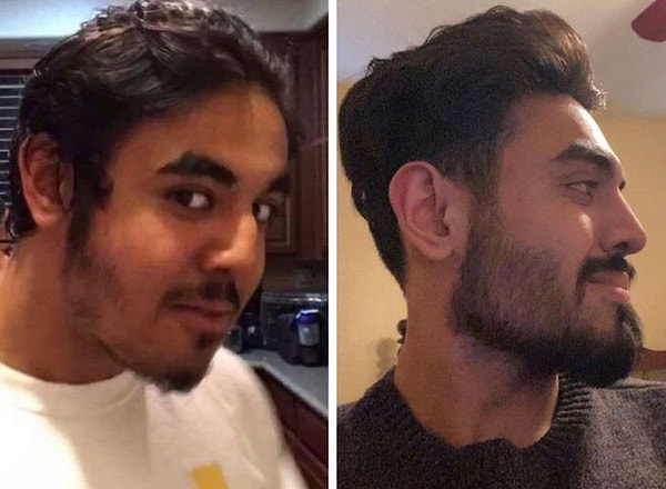 3. «После нескольких операций мой новый нос, мое новое лицо».