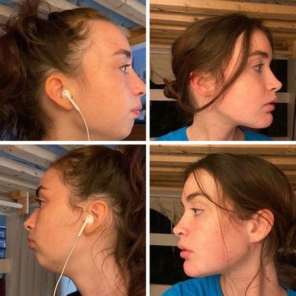 4. «5 месяцев после увеличения подбородка и операции на носу».