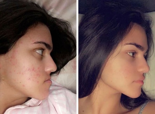 7. «Как изменилось мое лицо после операции на челюсти».