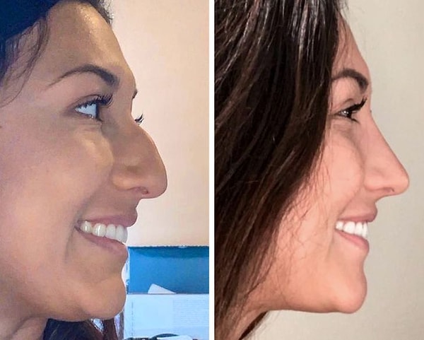 15. «Мне понравился мой новый нос. Я была так счастлив, что, даже заплакала».