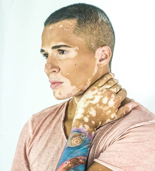 В течение нескольких лет он не мог смотреть в зеркало и не мог принять свое состояние.