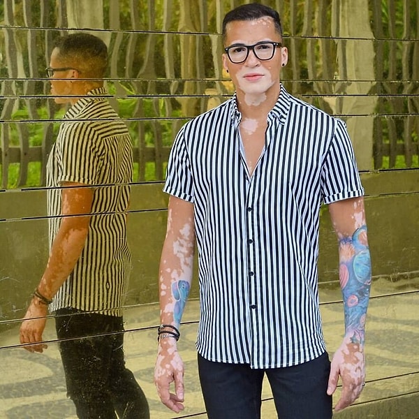 Незнакомцы избегали Роджера, думая, что его витилиго заразно, или высказывали ненавистные комментарии из-за того, как он выглядел.