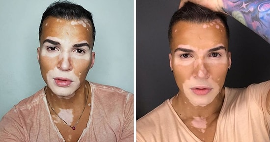 Поборов депрессию, этот бразильский парень, с болезнью витилиго, научился принимать себя таким, какой он есть