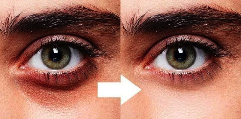 Yalnızca İyi Hissetmek Değil, İyi Görünmek Gerek: Göz Altı Işık Dolgusu ile Görünüşünüzden Yılları Geri Alın!