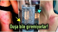 Hayattaki En Temel İhtiyaçlarımızdan Biri Olan Suya Karşı Alerjik Reaksiyon Göstermemiz Mümkün mü?