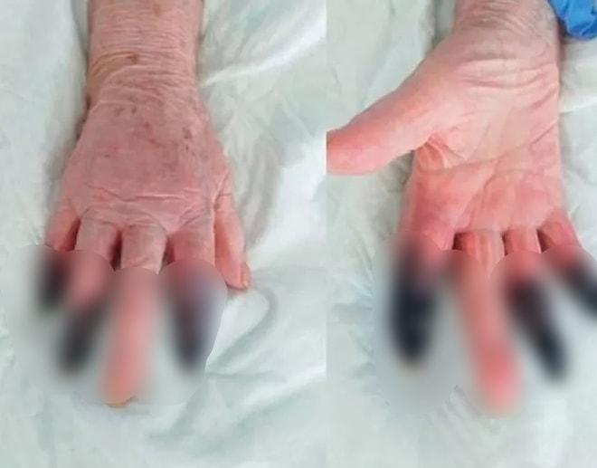 İtalya'da Koronavirüs Hastası Kadın Kangren Oldu, 3 Parmağı Kesildi