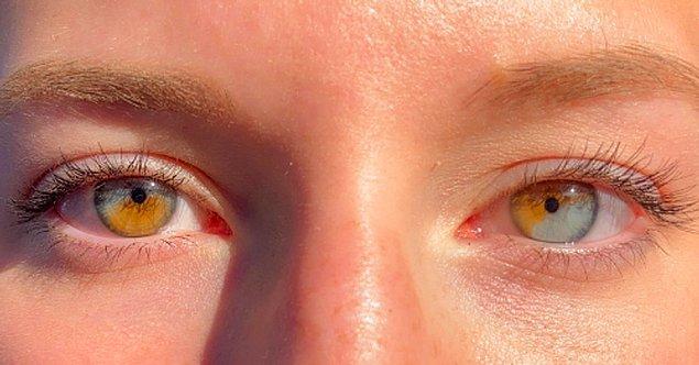 1. "İki gözümde de kısmi iris heterokromisi var."