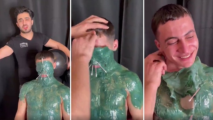 Vücudunun Büyük Bir Kısmı Ağda ile Kaplanan Adamın Adeta Deri Değiştirdiği O Anlar