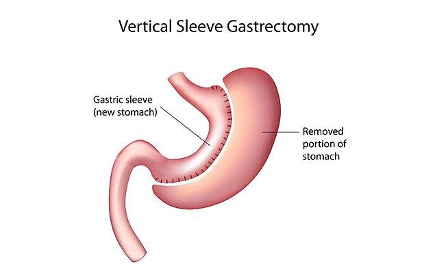 Mide küçültme ameliyatlarında iki farklı yöntem uygulanıyor: Gastrik bypass ve sleeve gastrektomi.