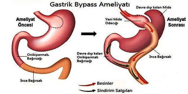 Gastrik bypass ameliyatında ise mide küçültülür, ince bağırsak ile küçültülen mide arasında bağlantı yapılır.