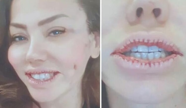 5. Şarkıcı Lara'nın dudaklarının küçültmek için geçirdiği operasyondan sonra yaptığı paylaşım herkesi şaşırttı!