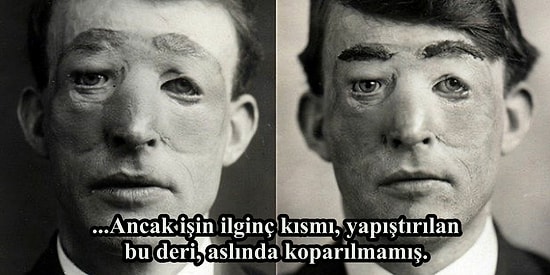 Plastik Cerrahinin İlk Başlarda Ne Kadar Korkunç Olduğunun Çarpıcı Bir Örneği: Walter Yeo