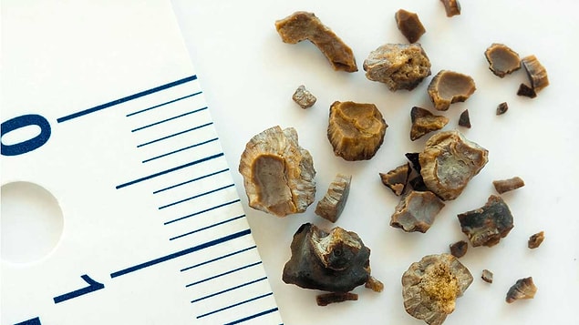 15. Böbrek taşı oluşumunu kolaylaştırır.