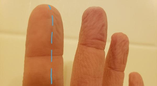 3. "İşaret parmağımdaki sinirlerden biri koptu ... Parmağımın yarısı artık buruşmuyor."