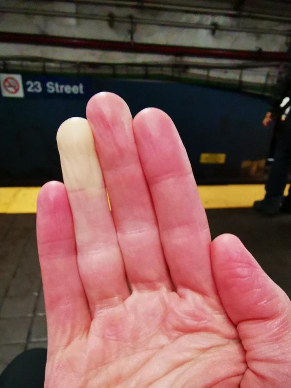 6. "Dışarısı soğuk olduğunda parmağımdaki Raynaud hastalığı böyle gözüküyor."
