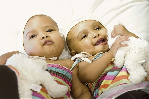Birbirlerine yapışık bir şekilde doğan ikizleri ayrılmak için yapılan cerrahi işleme bir bakalım.