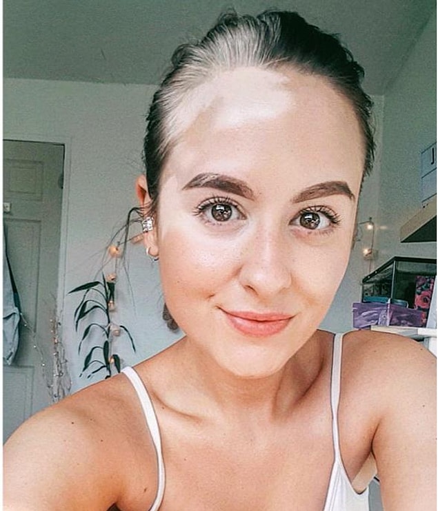 5. "16 yıl boyunca sakladım ama artık vitiligo hastalığımı seviyorum."