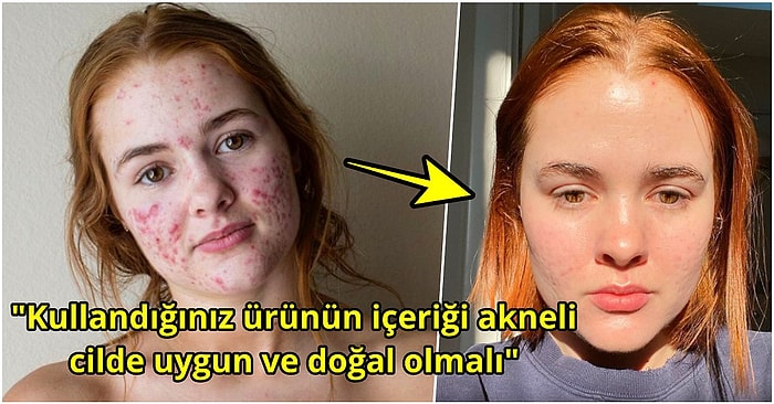 Sivilce Sorunlarıyla Nasıl Başa Çıktıklarını Tek Tek Anlatan Kişilerden Altın Değerinde Tavsiyeler